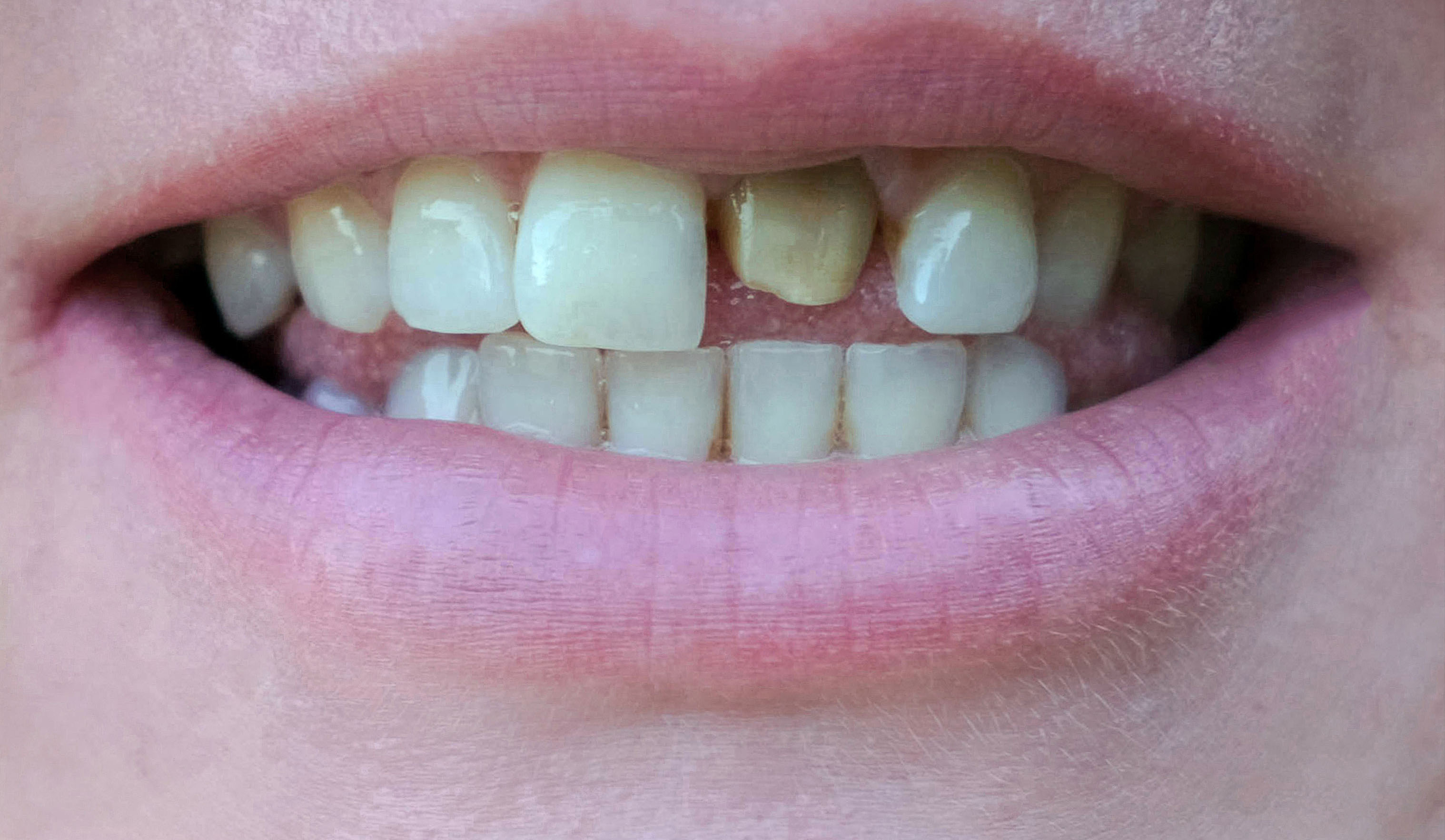 teeth before